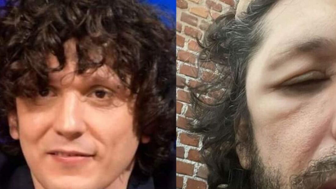 Ermal Meta e il gonfiore su viso e testa