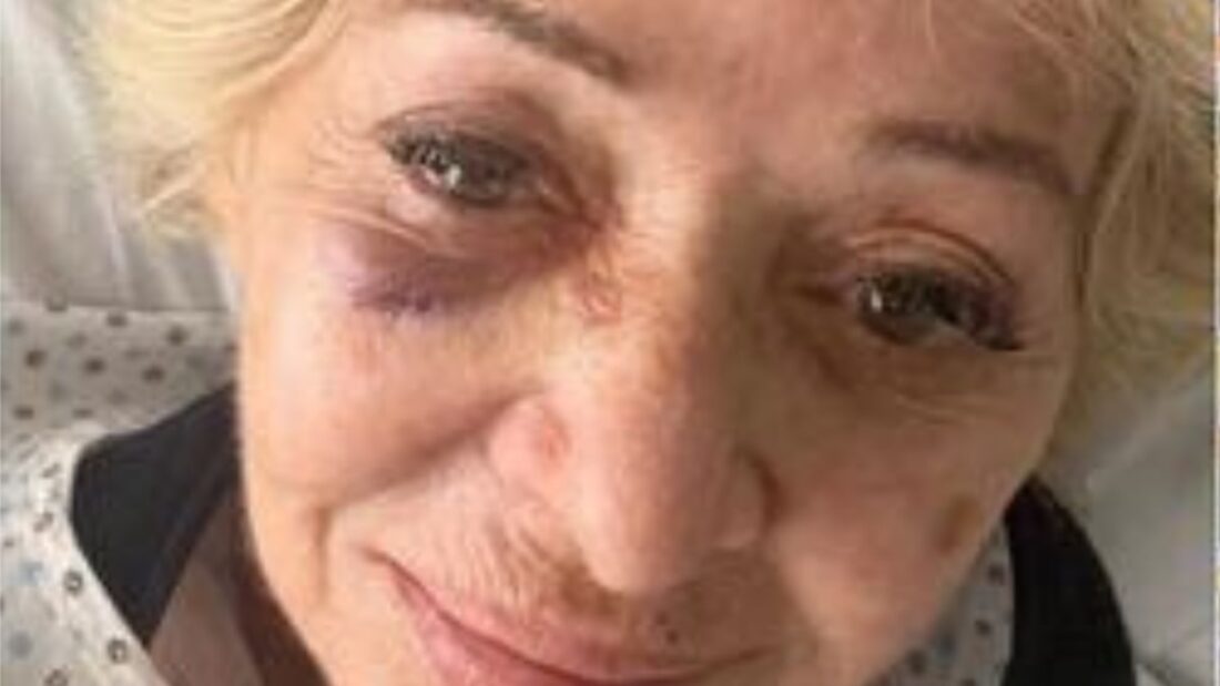 Il volto tumefatto di Enrica Bonaccorti