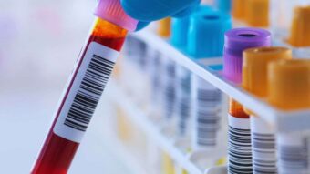 i sintomi della carenza di ferro